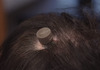 „Neuralink“ го изврши првото вградување чип во човечки мозок – Маск: Пациентот е во добра состојба