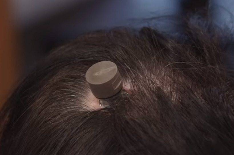 „Neuralink“ го изврши првото вградување чип во човечки мозок – Маск: Пациентот е во добра состојба