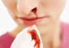Што значи изненадното течење на крв од носот?