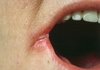 Ви се појавија пукнатини на устата – не занемарувајте го овој симптом, телото ви испраќа порака