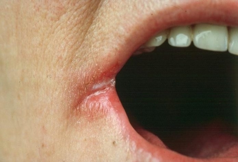 Ви се појавија пукнатини на устата – не занемарувајте го овој симптом, телото ви испраќа порака
