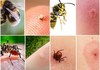 Еве како изгледаат најчестите убоди од инсекти: Совет плус за прва помош во овие ситуации!